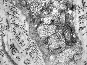 M, 3y. | lipofuscinosis